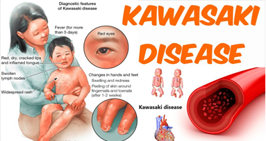 Kawasaki Disease