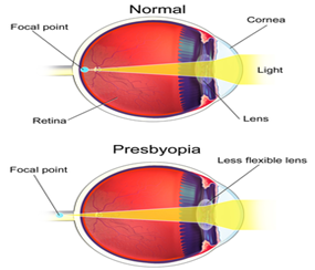 Presbyopia